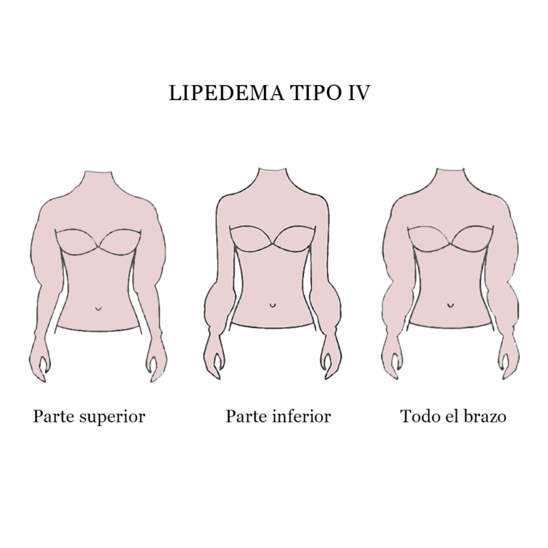 Phases du lipœdème - Clinica Lipedema Madrid