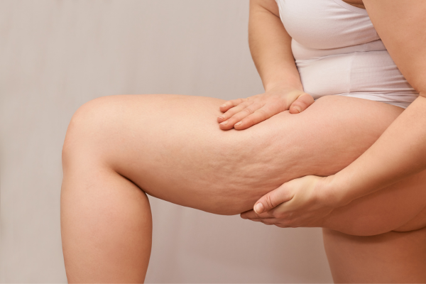 Recommendations after liposuction to treat lipedema